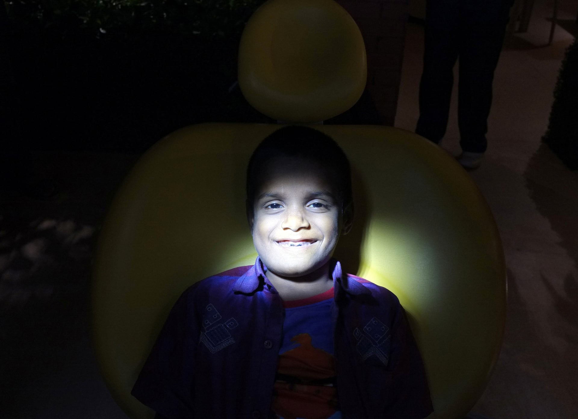 შვიდი წლის ინდოელი ბიჭი, რომელსაც პირის ღრუში 526 კბილი აღმოაჩნდა